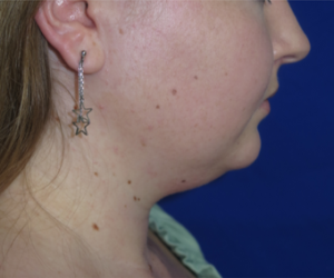 Neck Lipo Case 6341 Before Photo Neck Lipo