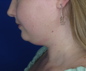 Neck Lipo Case 6341 Before Photo Neck Lipo