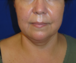 FACEology Lift / Neck Lift