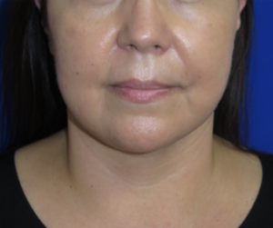 FACEology Lift / Neck Lift Case 6342 After Photo FACEology Lift / Neck Lift