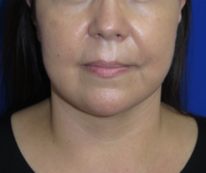 FACEology Lift / Neck Lift