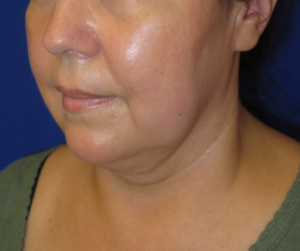 FACEology Lift / Neck Lift Case 6342 Before Photo FACEology Lift / Neck Lift