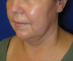 FACEology Lift / Neck Lift