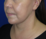 FACEology Lift / Neck Lift