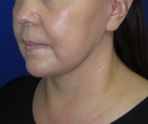 FACEology Lift / Neck Lift Case 6342 After Photo FACEology Lift / Neck Lift