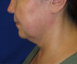 FACEology Lift / Neck Lift Case 6342 Before Photo FACEology Lift / Neck Lift