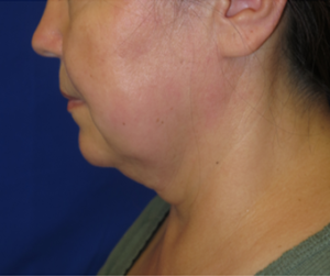 FACEology Lift / Neck Lift