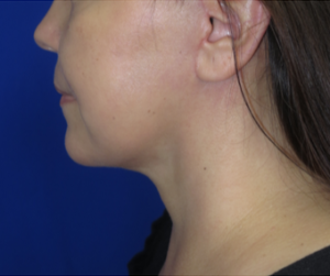 FACEology Lift / Neck Lift Case 6342 After Photo FACEology Lift / Neck Lift