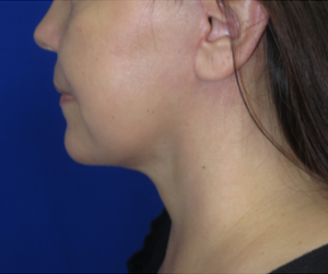 FACEology Lift / Neck Lift