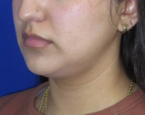 Neck Lipo Case 6397 Before Photo Neck Lipo