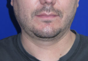 Chin Liposuction Case 6405 Before Photo Chin Liposuction