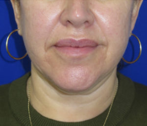 FACEology Lift / Neck Lift Case 6387 Before Photo FACEology Lift / Neck Lift