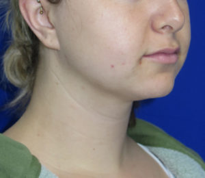 Chin Liposuction Case 6422 Before Photo Chin Liposuction