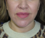 FACEology Lift / Neck Lift