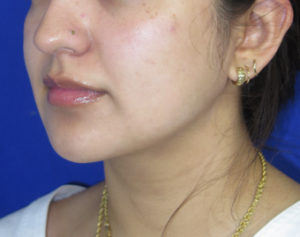 Neck Lipo Case 6397 After Photo Neck Lipo