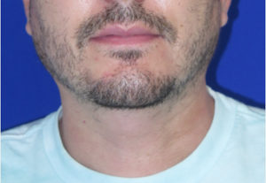 Chin Liposuction Case 6405 After Photo Chin Liposuction