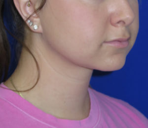Chin Liposuction Case 6422 After Photo Chin Liposuction
