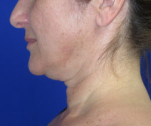 FACEology Lift / Neck Lift Case 6392 Before Photo FACEology Lift / Neck Lift