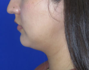 Neck Lipo Case 6397 Before Photo Neck Lipo