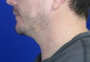 Chin Liposuction Case 6405 Before Photo Chin Liposuction