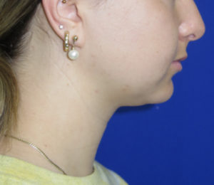 Chin Liposuction Case 6422 Before Photo Chin Liposuction