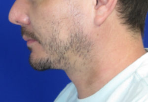 Chin Liposuction Case 6405 After Photo Chin Liposuction