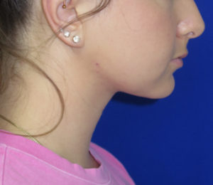 Chin Liposuction Case 6422 After Photo Chin Liposuction