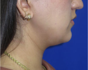 Neck Lipo Case 6397 Before Photo Neck Lipo