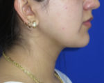Neck Lipo