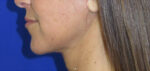 FACEology Lift / Neck Lift