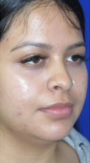 Chin Liposuction