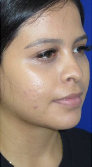 Chin Liposuction