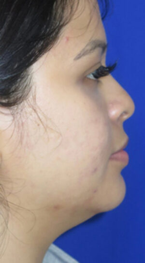 Chin Liposuction