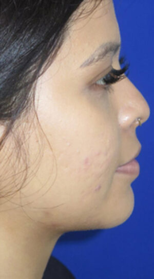 Chin Liposuction