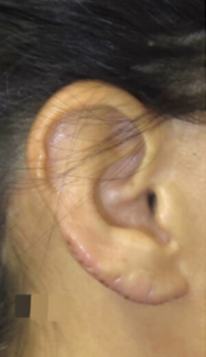 Ear Surgery Case 6575 After Photo Ear Surgery
