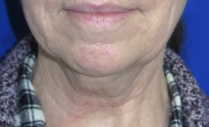 FACEology Lift / Neck Lift