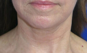 FACEology Lift / Neck Lift