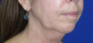 FACEology Lift / Neck Lift