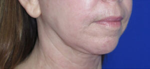 FACEology Lift / Neck Lift