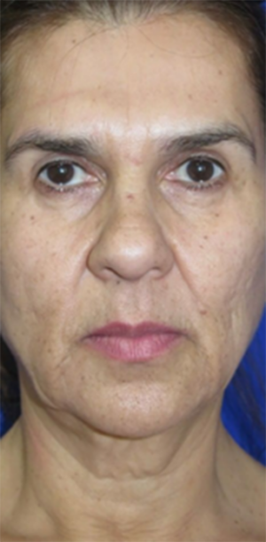 FACEology Lift / Neck Lift