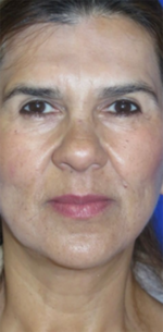 FACEology Lift / Neck Lift