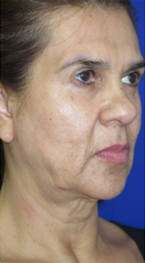 FACEology Lift / Neck Lift