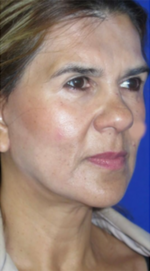 FACEology Lift / Neck Lift