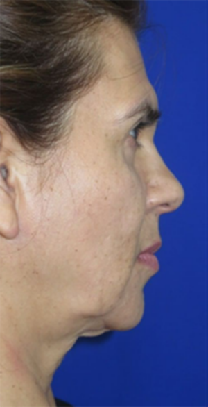 FACEology Lift / Neck Lift