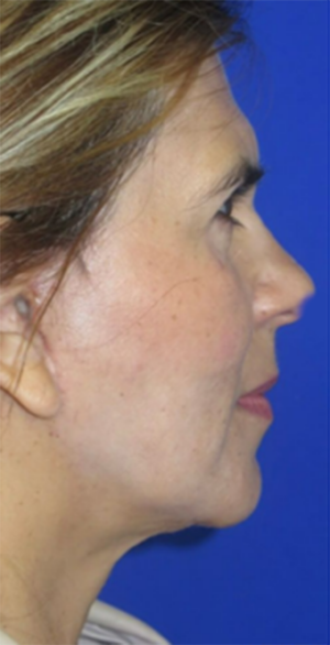 FACEology Lift / Neck Lift