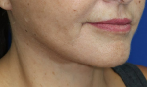 FACEology Lift / Neck Lift Case 6595 After Photo FACEology Lift / Neck Lift