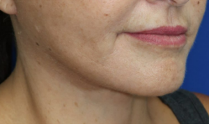 FACEology Lift / Neck Lift