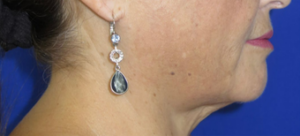 FACEology Lift / Neck Lift Case 6595 Before Photo FACEology Lift / Neck Lift