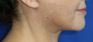 FACEology Lift / Neck Lift Case 6595 After Photo FACEology Lift / Neck Lift
