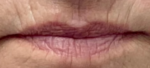 Lip Augmentation